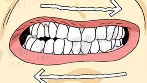成年人做窝沟封闭有必要么,牙齿做窝沟封闭的最佳时间(图1)